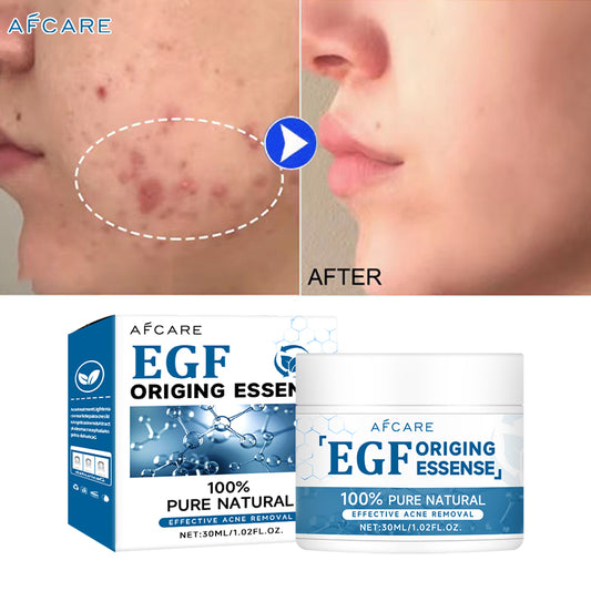 EGF Face Cream Remover Pimple Repair Acne Treatment Lightening Acne