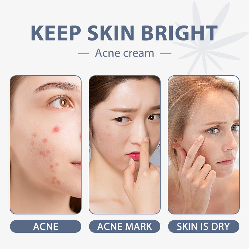 "Clear Skin Ahead: Acne Cream for Blemish-Free Beauty!