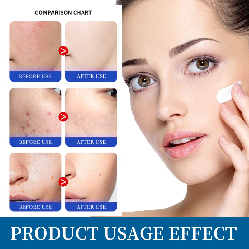 EGF Face Cream Remover Pimple Repair Acne Treatment Lightening Acne